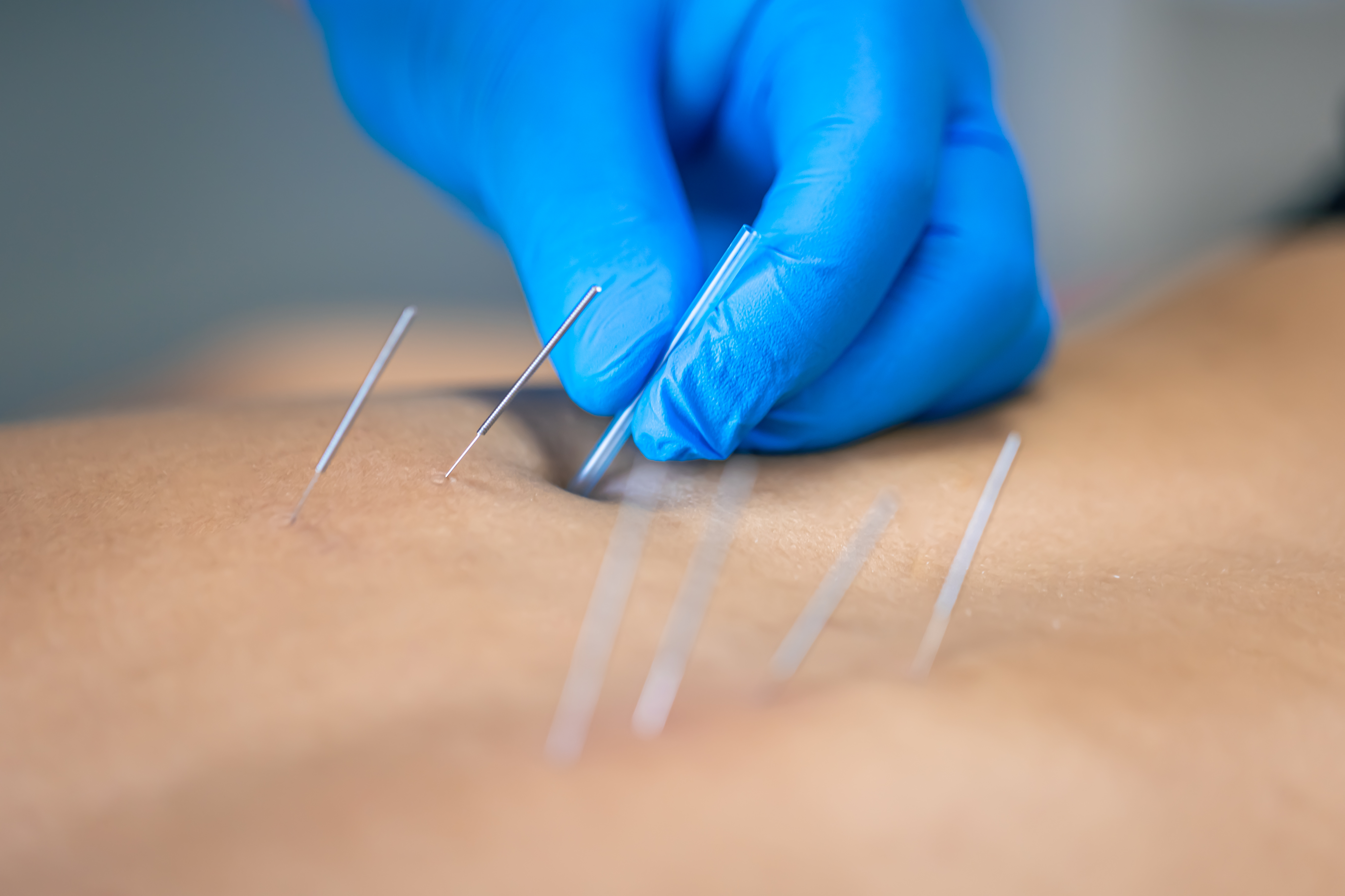 Séance d'acupuncture générale avec Julie Stiernet